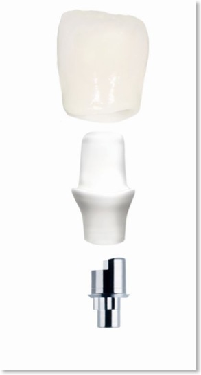 krone_implantat_emergenzprofil